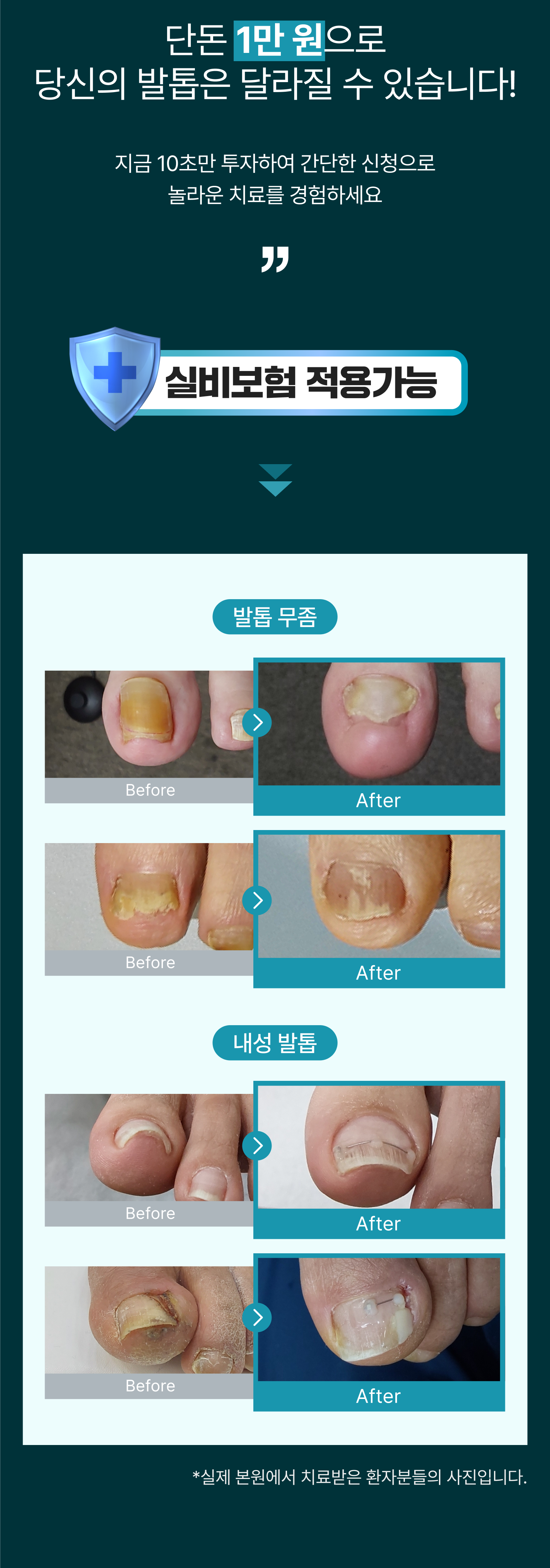 르샤인의원 문제성 발톱 클리닉
