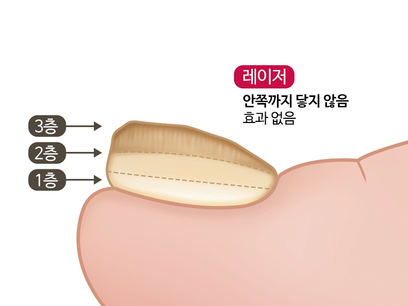 foot podol process 1