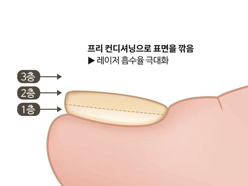 foot podol process 1