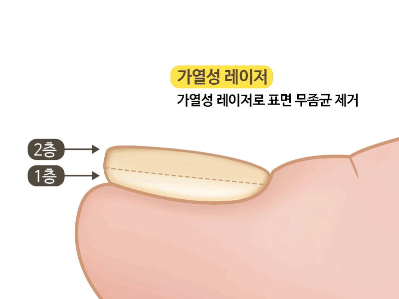foot podol process 1
