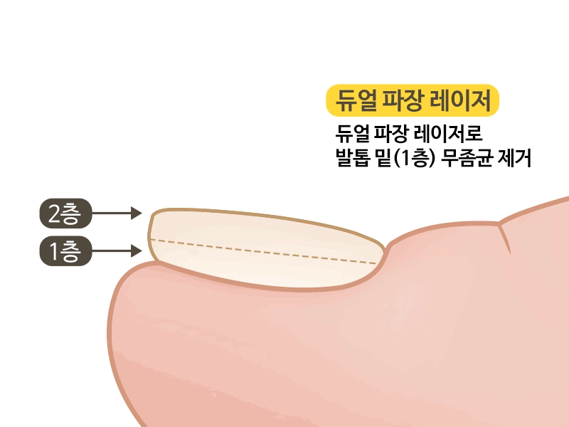 foot podol process 1